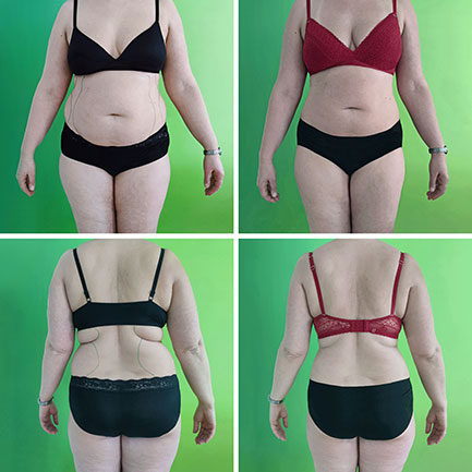 Vorher-nachher-Foto Figurformung mit LDT